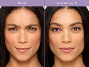 Botox Injection Before And After Photos - Suncoast Skin Solutions